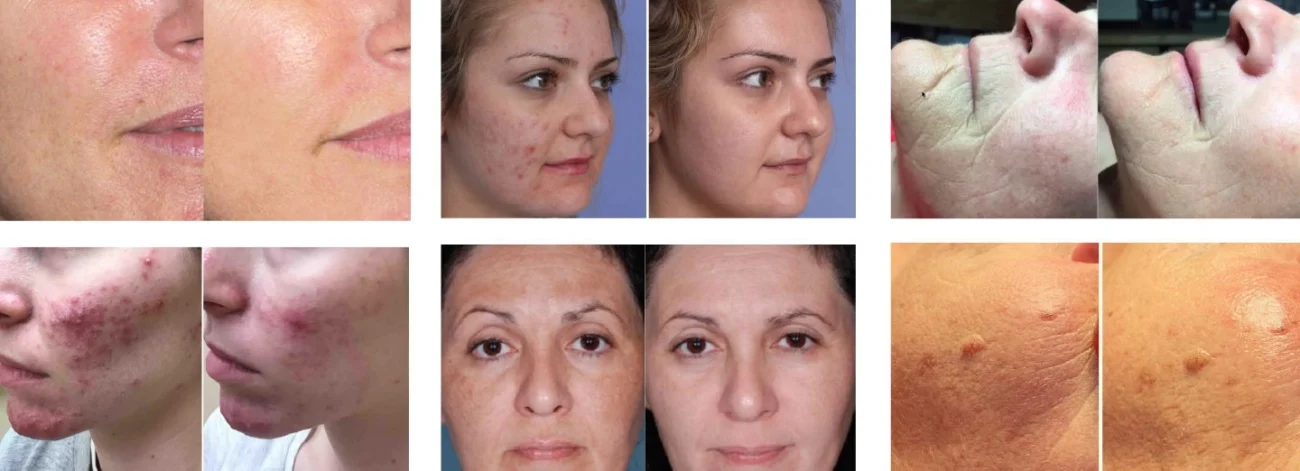 NUBWAY | How to Choose the Right PDT Machine for Your Clinic or Beauty Spa