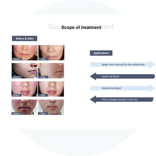 Spider Vein Removal Machine - Image 4